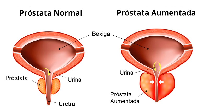 Prostata verhärtet was bedeutet das