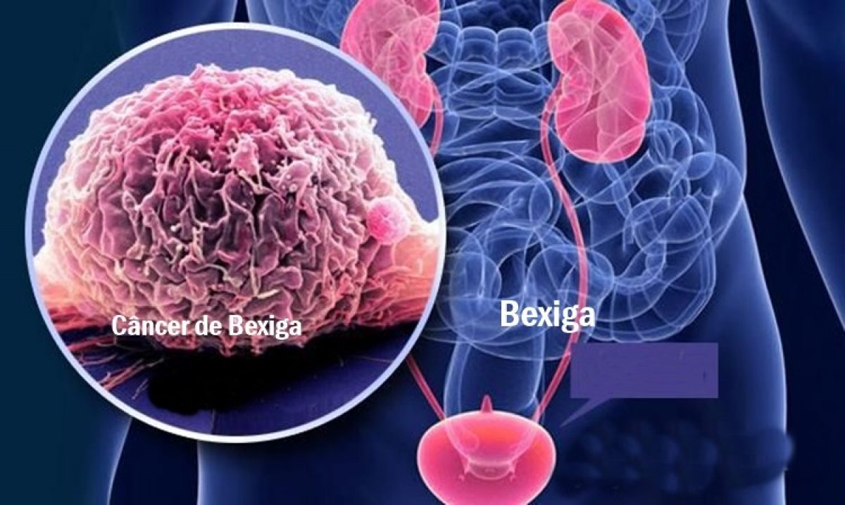 Câncer de Bexiga: sintomas e fatores de risco | Dr Paulo Salustiano
